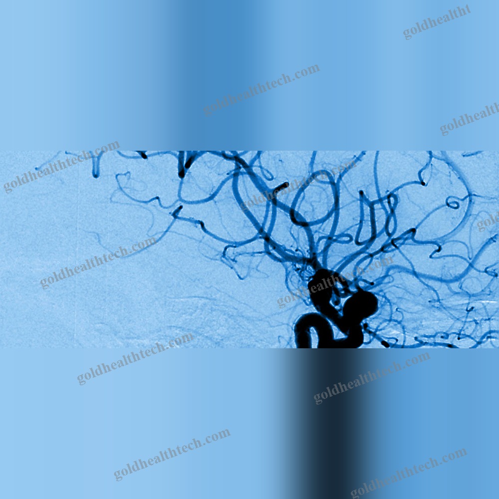 Embolization Coil