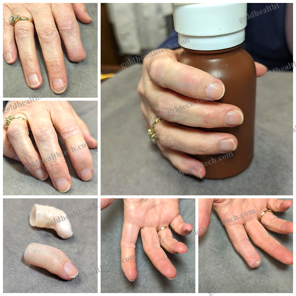 Finger Cosmetic Prosthesis