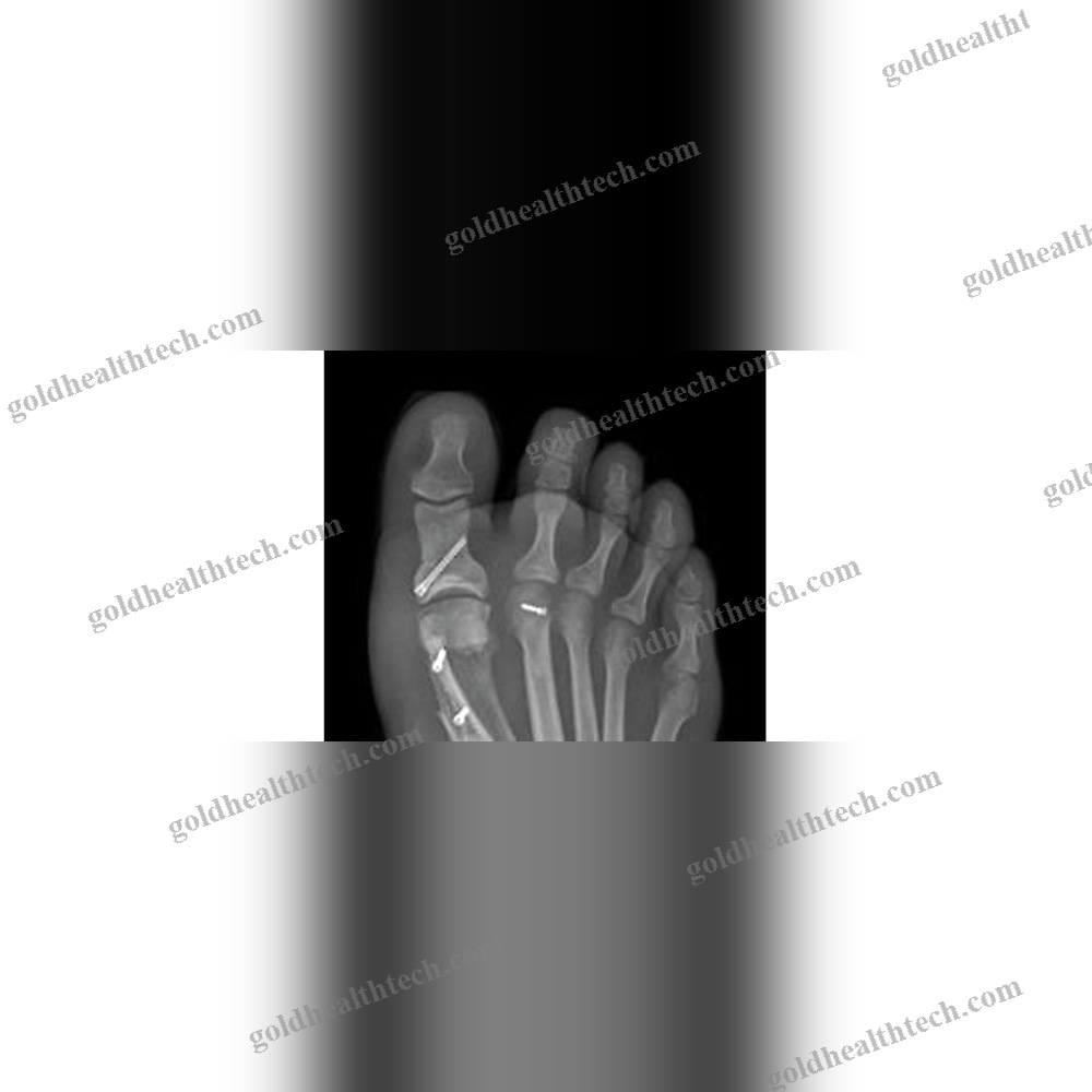 Hallux Valgus Osteotomy Screw