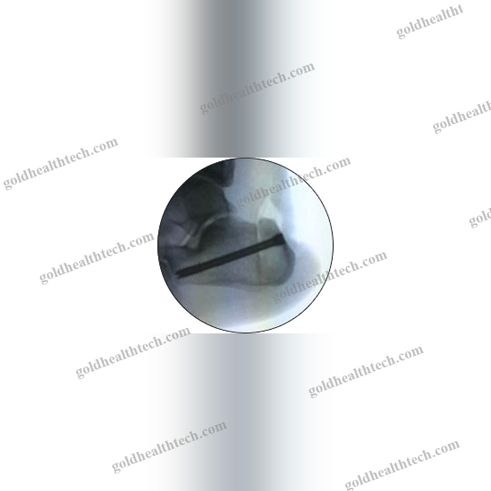 Hindfoot Arthrodesis Screw