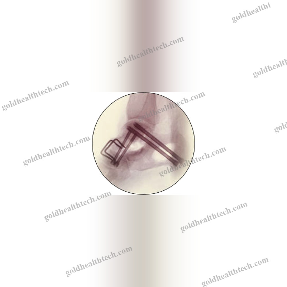 Hindfoot Arthrodesis Screw