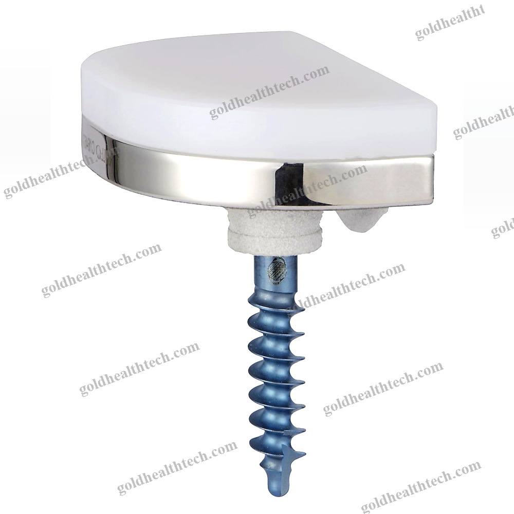 Unicompartmental Knee Prosthesis