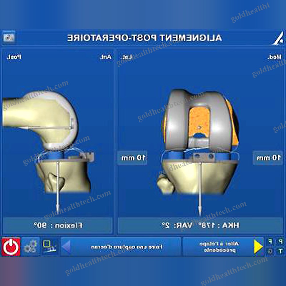 Knee Prosthesis Positioning Surgical Navigation System