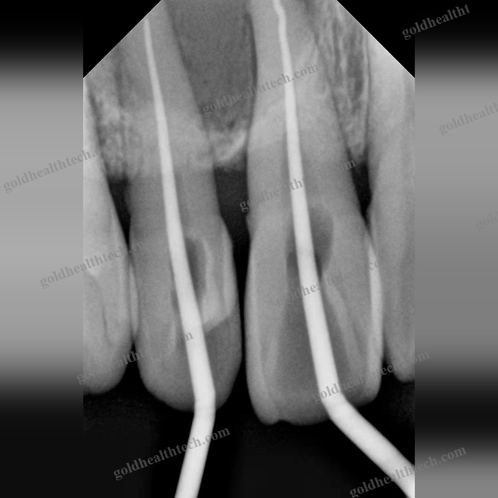 Dental Radiography Intra-Oral Detector