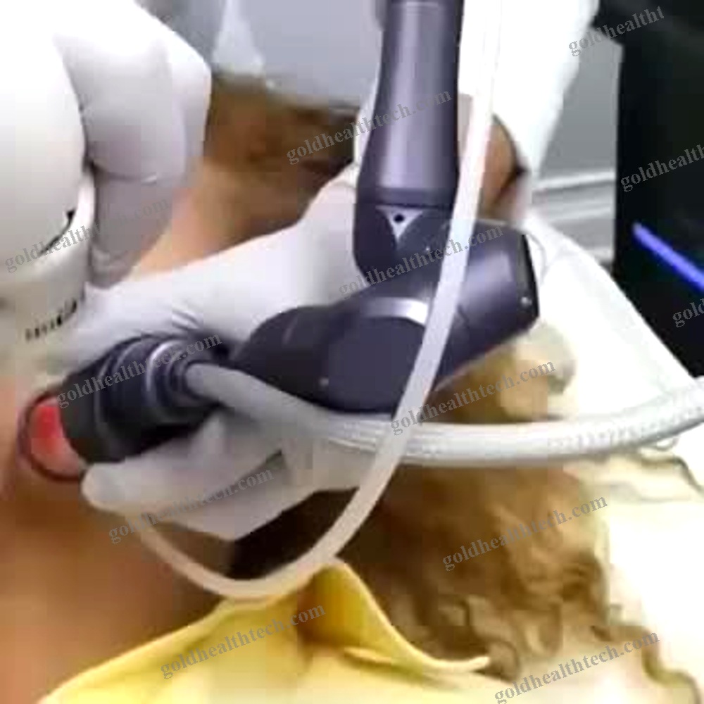 Scar Removal Laser