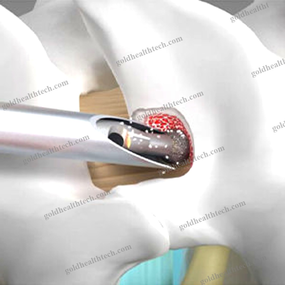Spine Surgery Burr