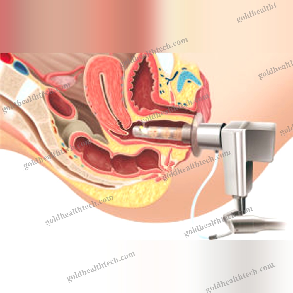 Gynecological Surgery Laser