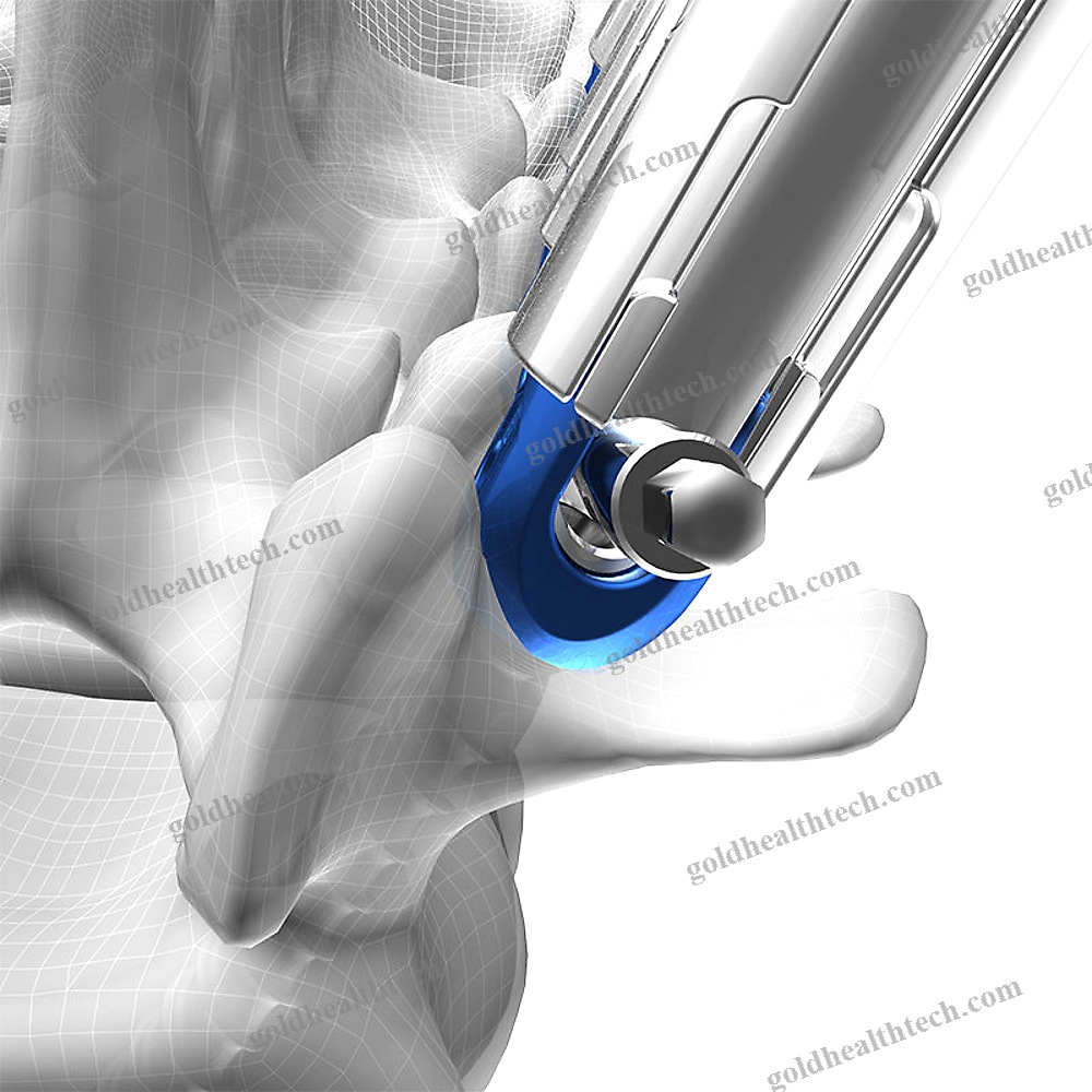 Minimally Invasive Pedicle Screw Positioning System