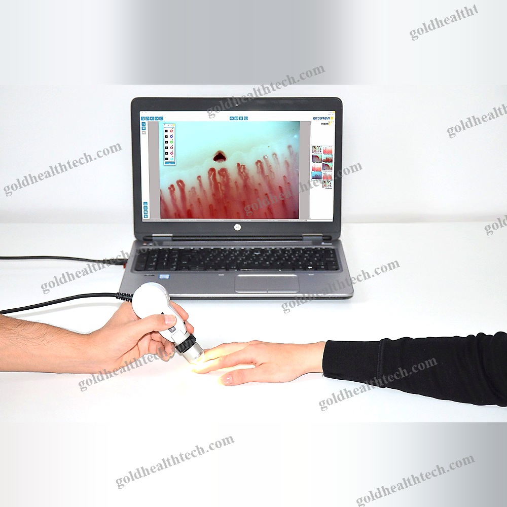 Video Capillaroscope