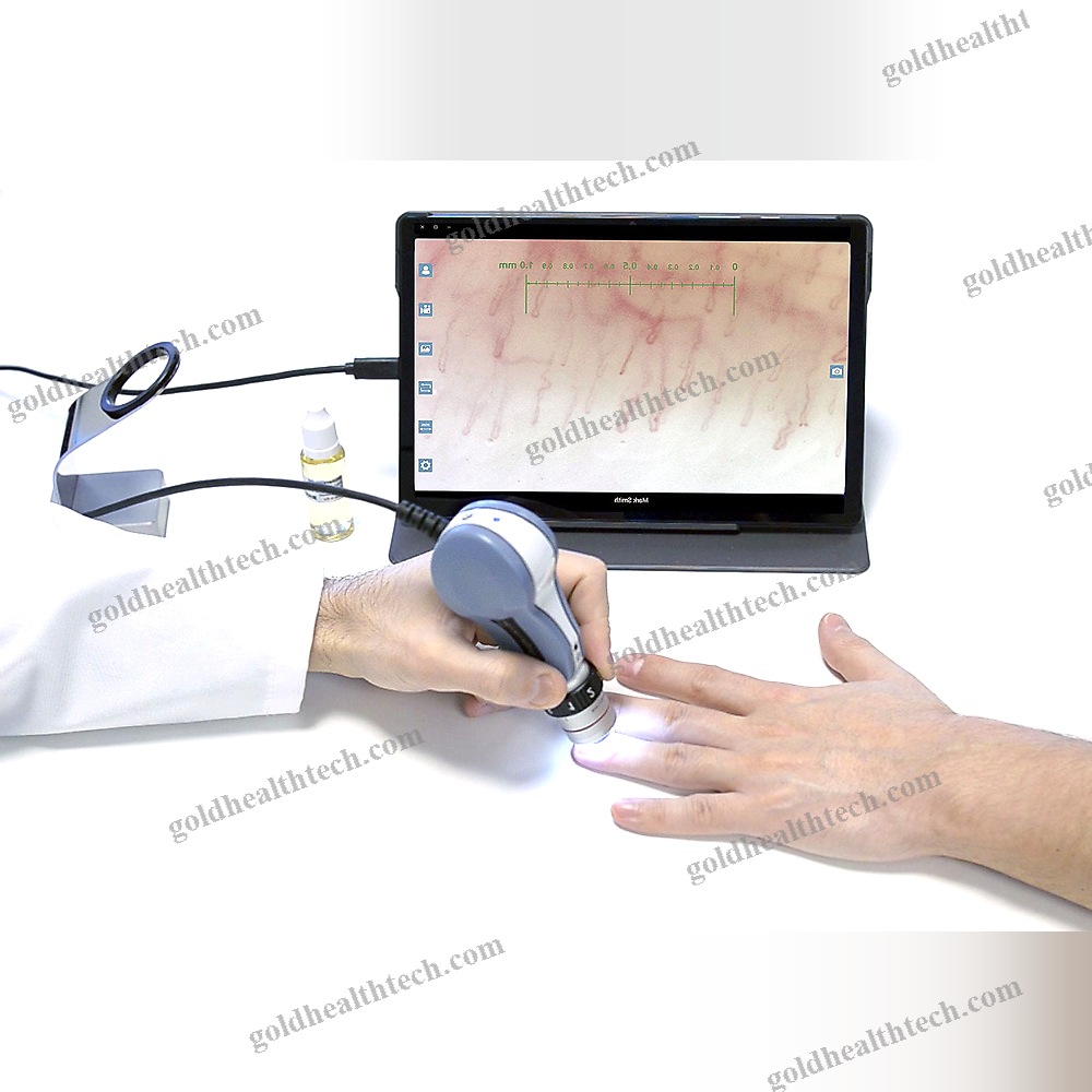 Video Capillaroscope