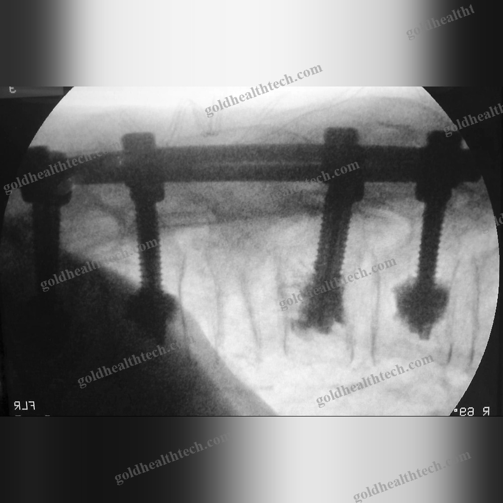 Thoraco-Lumbar Pedicle Screw