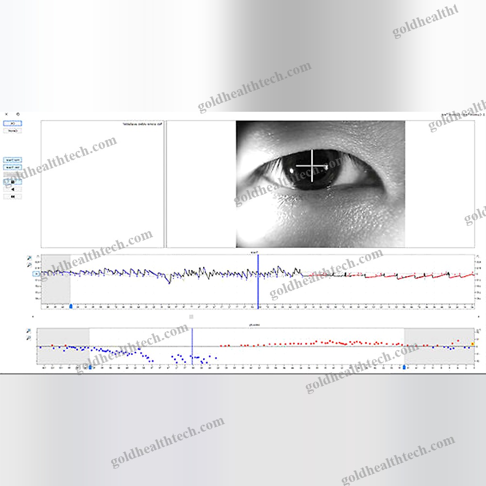 Vidéonystagmoscope