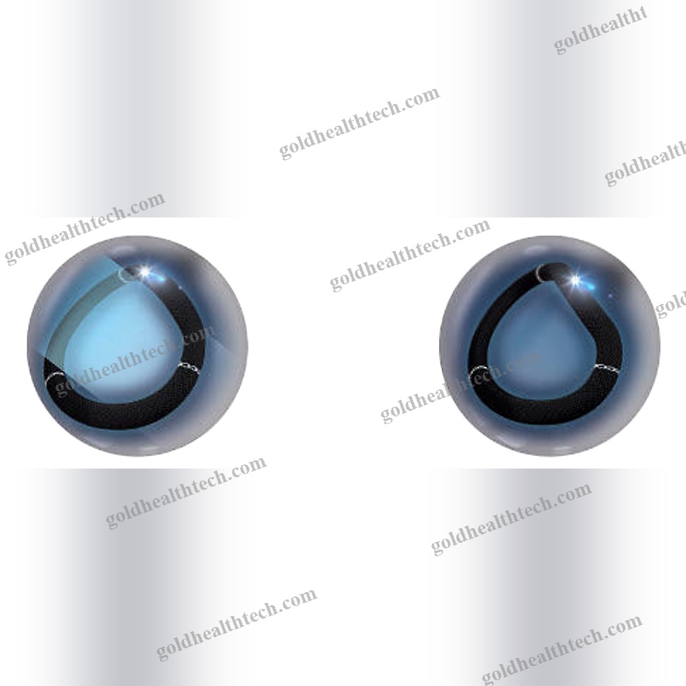 Mitral Annuloplasty Ring