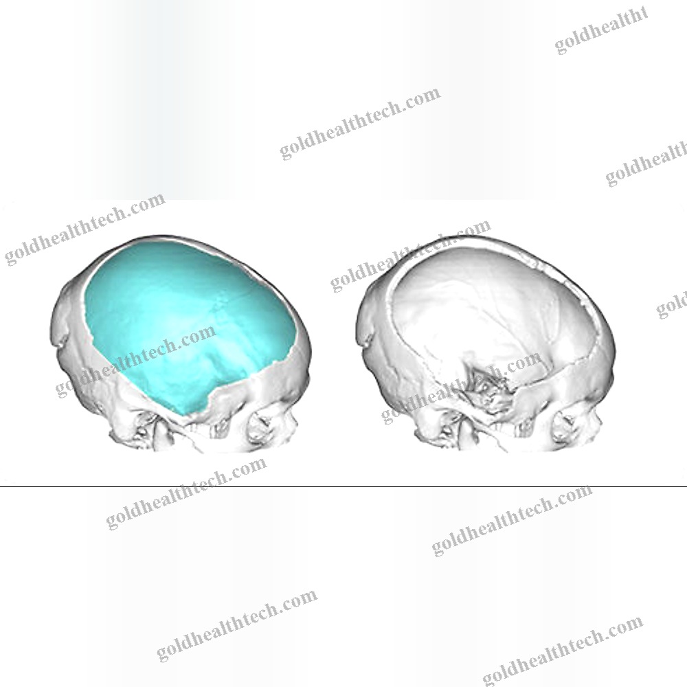 Custom-Made Cranial Implant