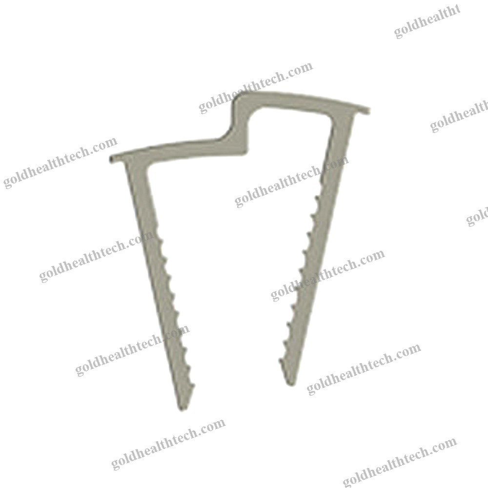 Calcaneal Displacement Osteotomy Bone Staple
