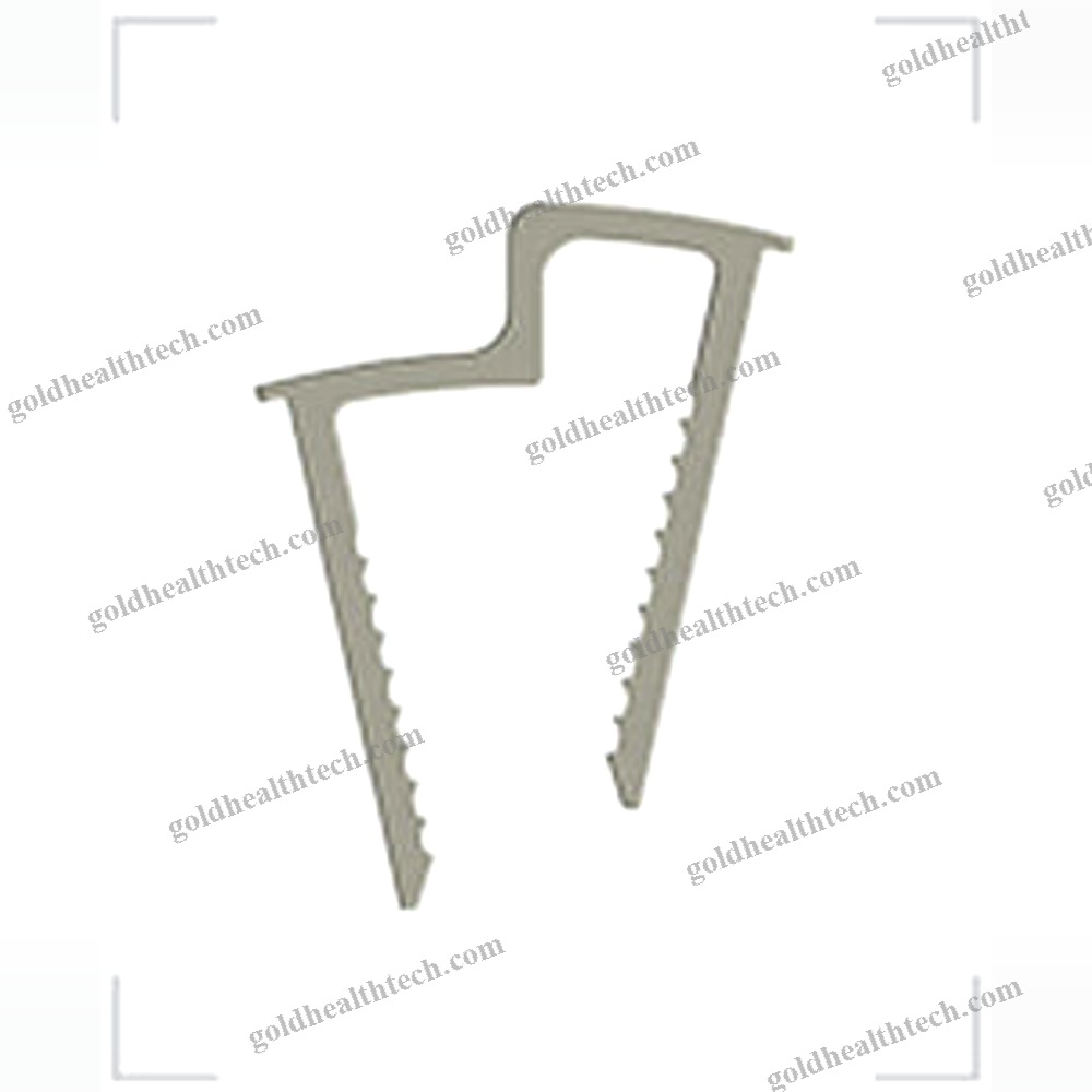Calcaneal Displacement Osteotomy Bone Staple