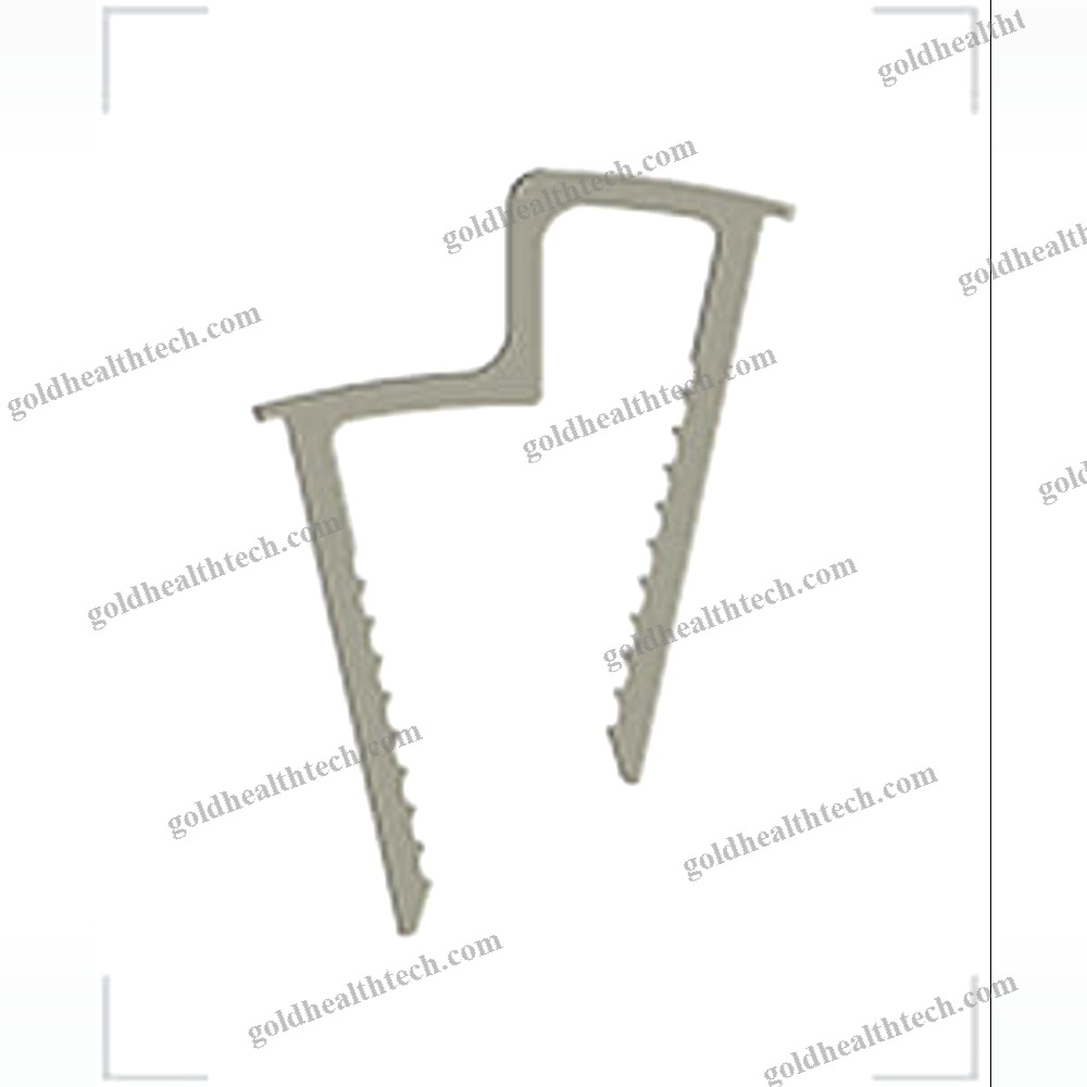 Calcaneal Displacement Osteotomy Bone Staple