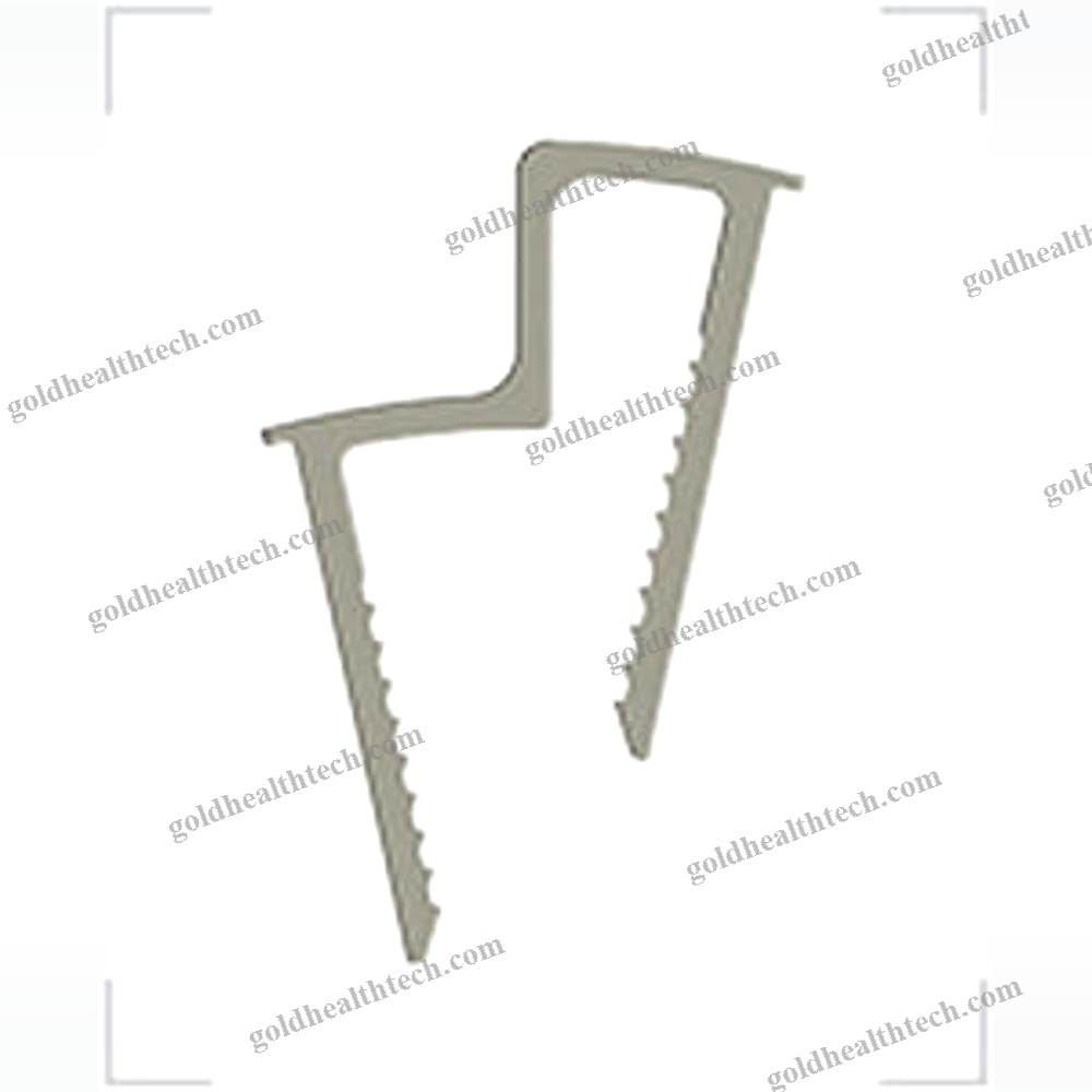 Calcaneal Displacement Osteotomy Bone Staple