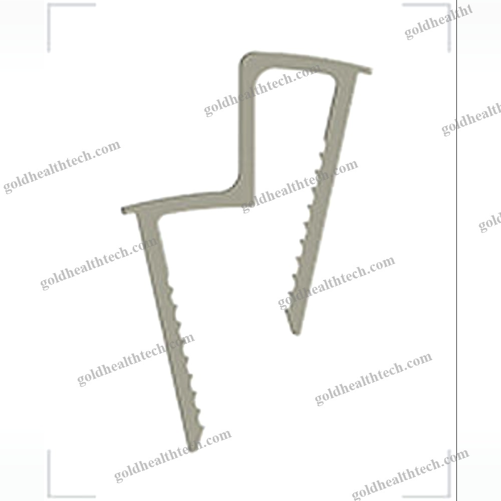 Calcaneal Displacement Osteotomy Bone Staple