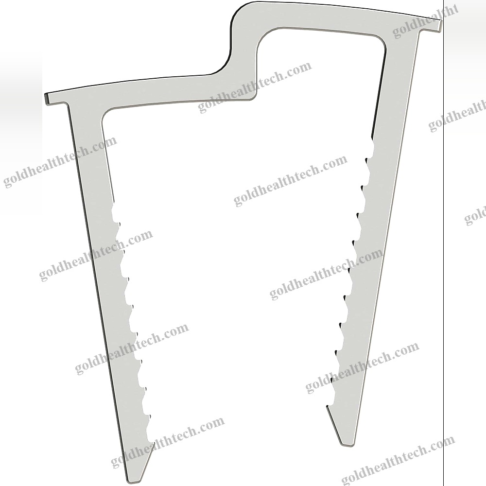 Calcaneal Displacement Osteotomy Bone Staple