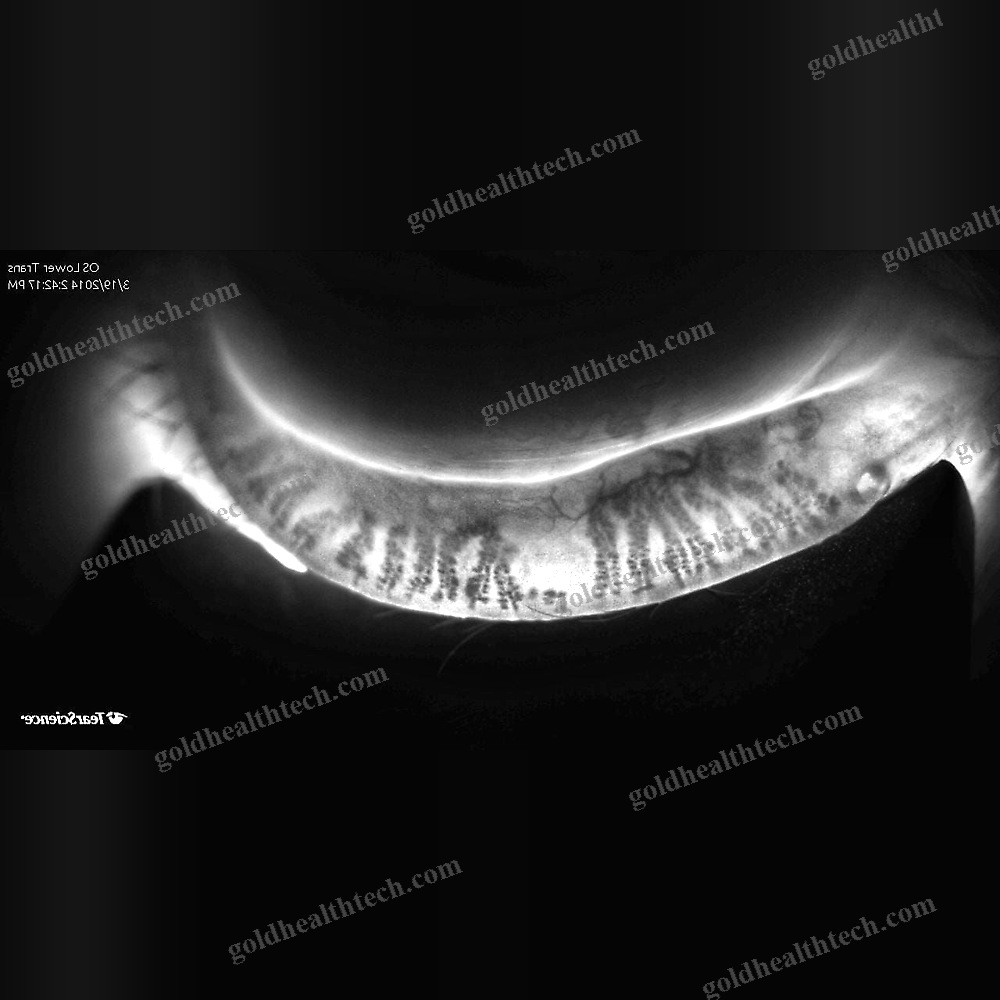 Meibography Dry Eye Diagnosis System