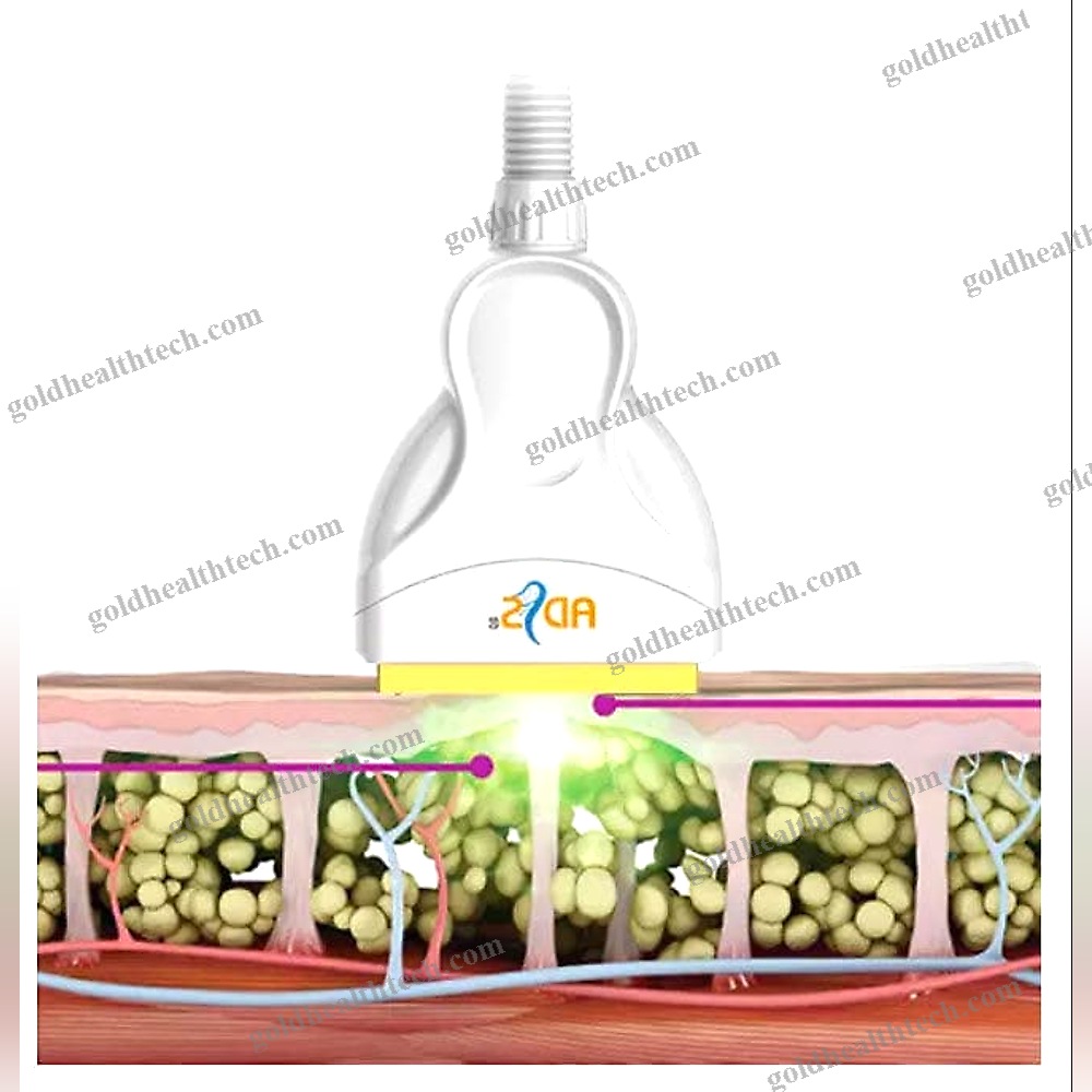 Dermatology Laser