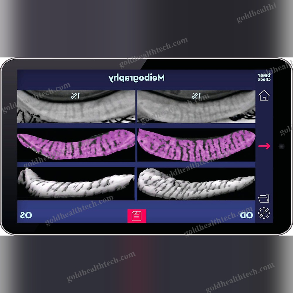 Meibography Dry Eye Diagnosis System