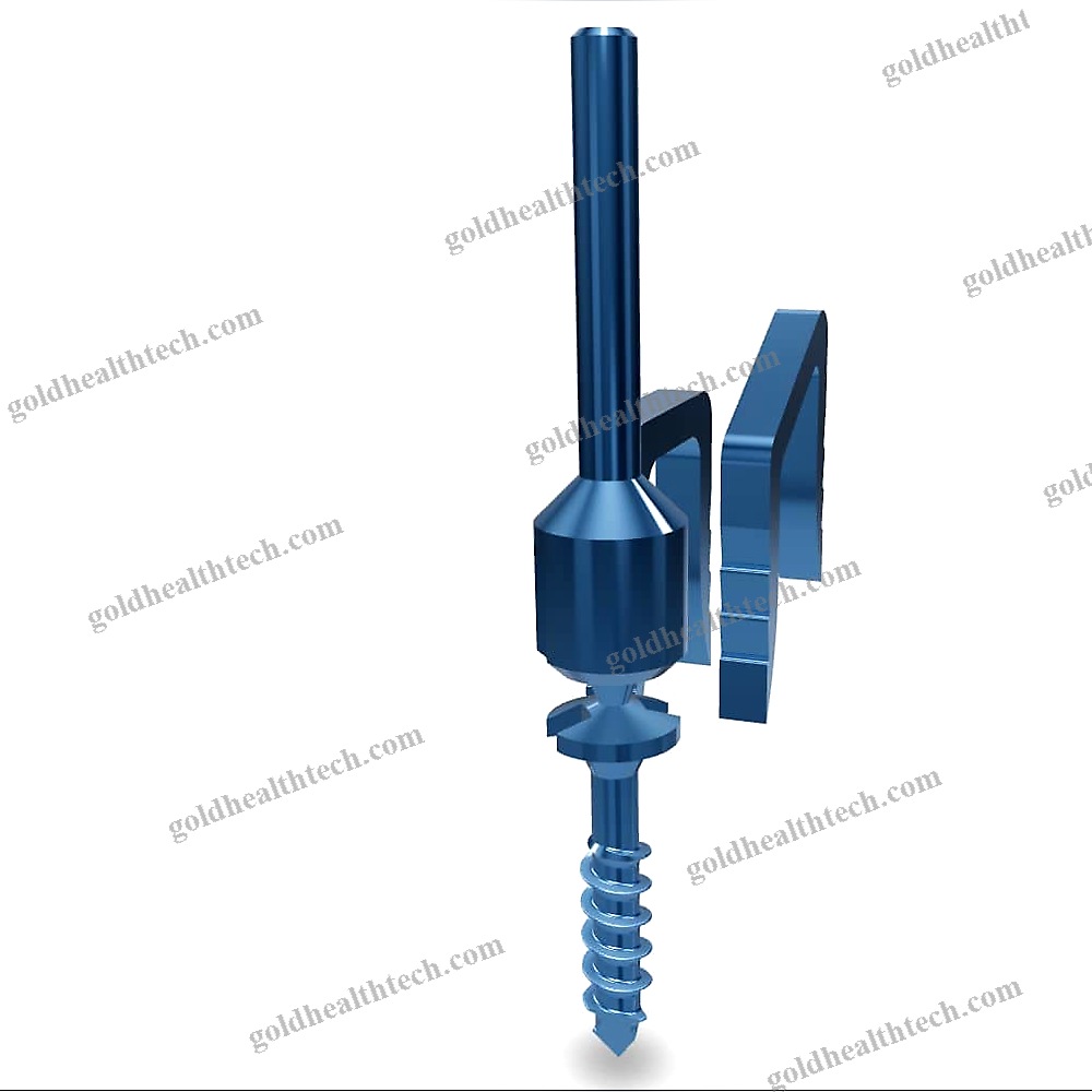 Akin Osteotomy Bone Staple