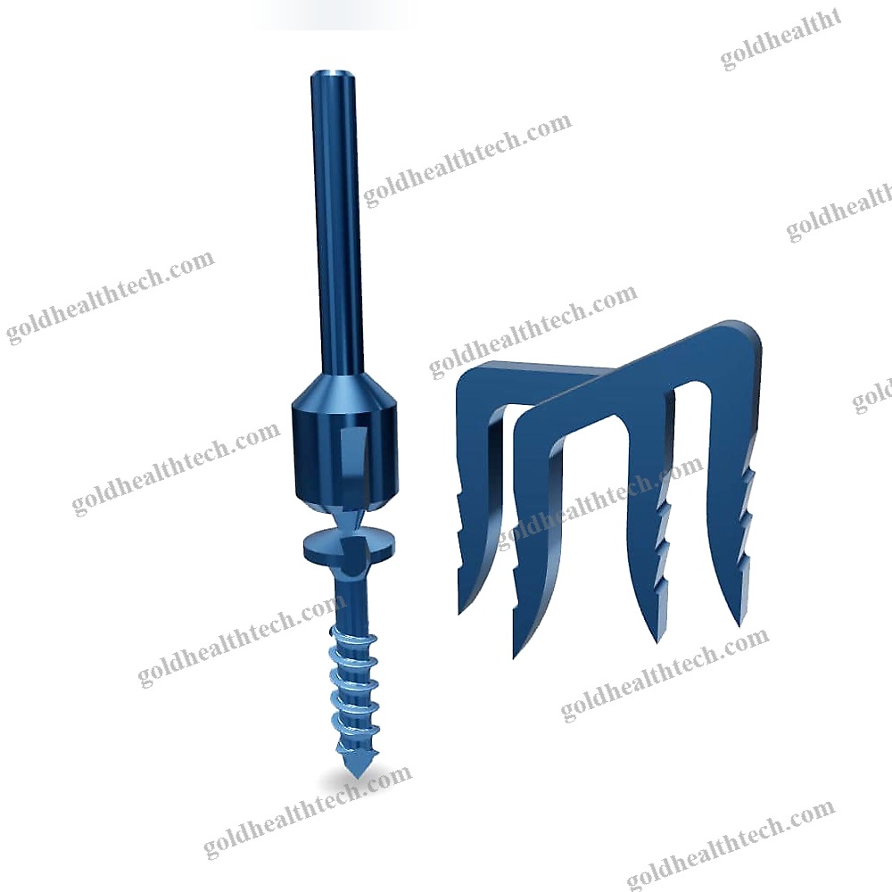 Akin Osteotomy Bone Staple