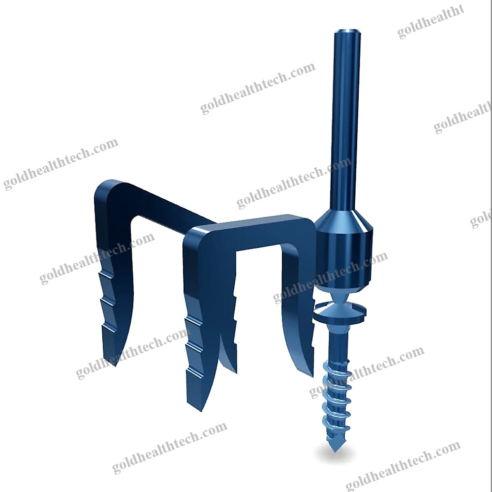 Akin Osteotomy Bone Staple