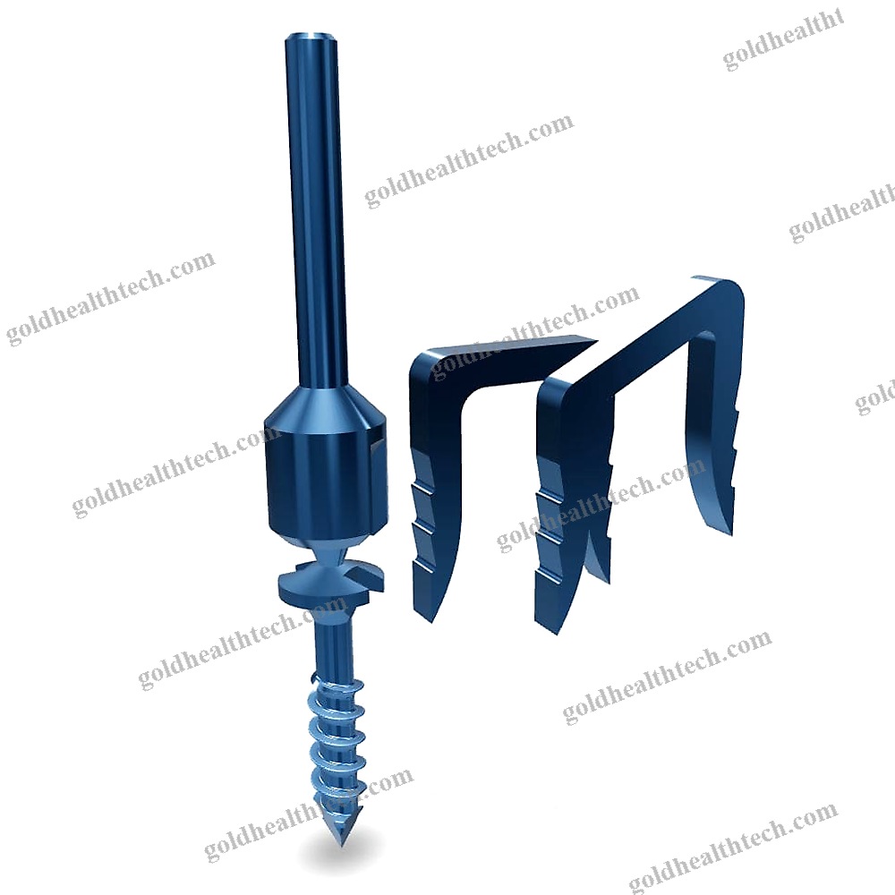 Akin Osteotomy Bone Staple