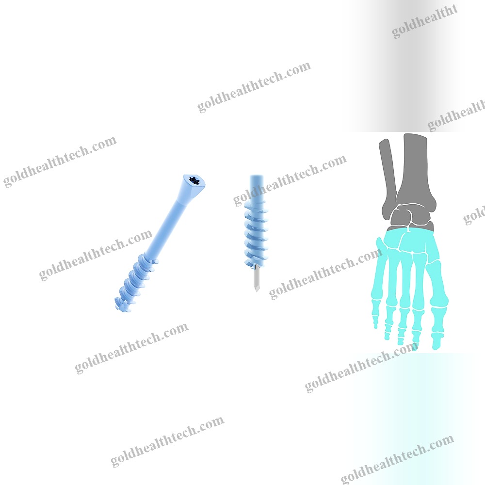 Metatarsal Bone Osteotomy Screw