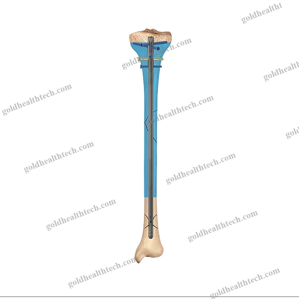 Tibial Intramedullary Nail