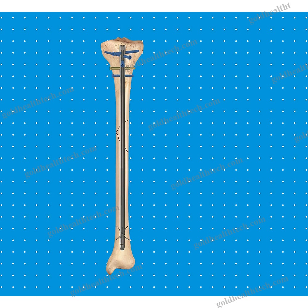 Tibial Intramedullary Nail