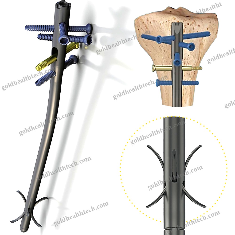 Tibial Intramedullary Nail