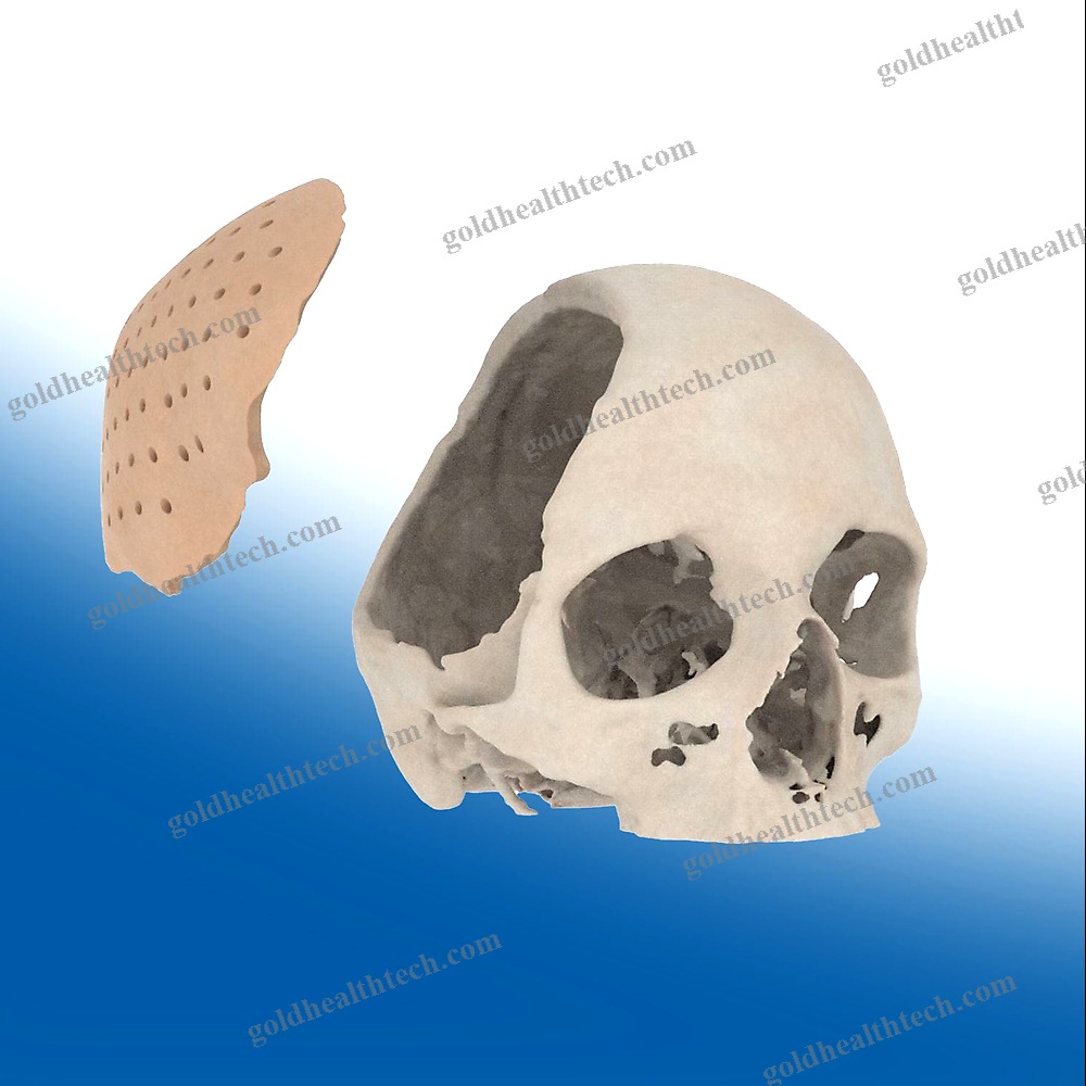 Custom-Made Cranial Implant