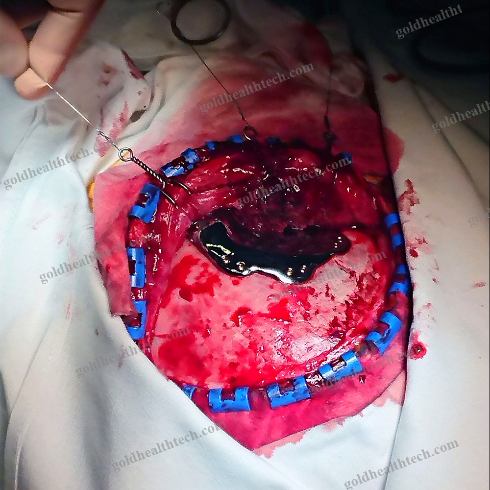Custom-Made Cranial Implant
