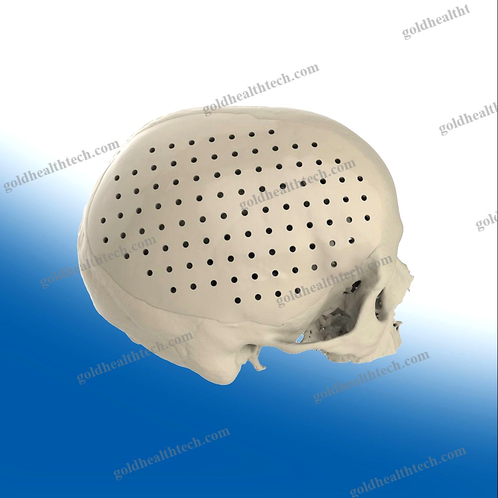 Custom-Made Cranial Implant
