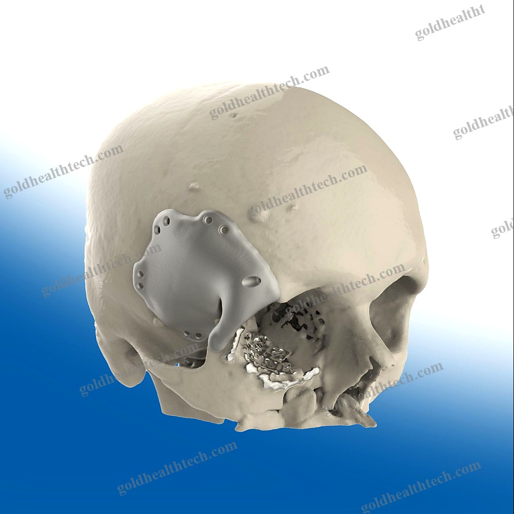 Custom-Made Cranial Implant