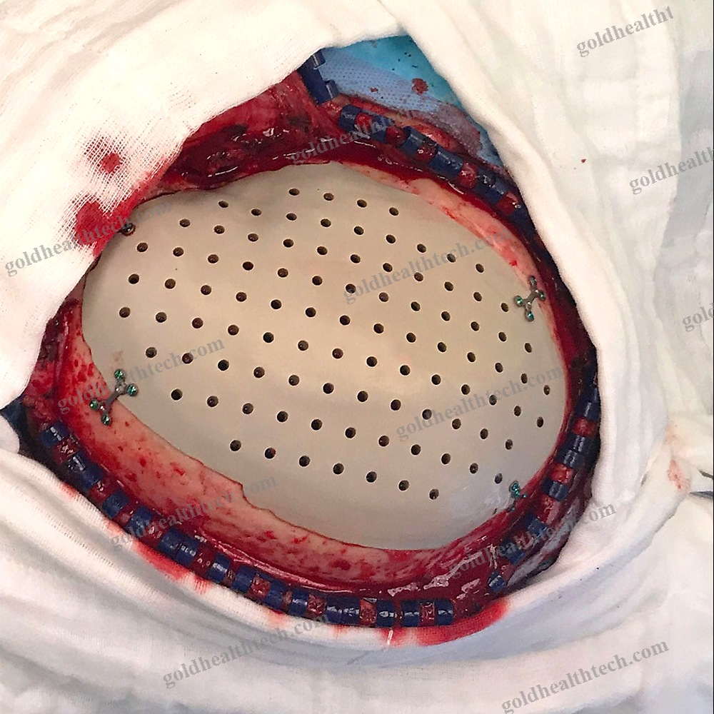 Custom-Made Cranial Implant