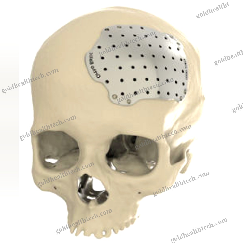 Custom-Made Cranial Implant