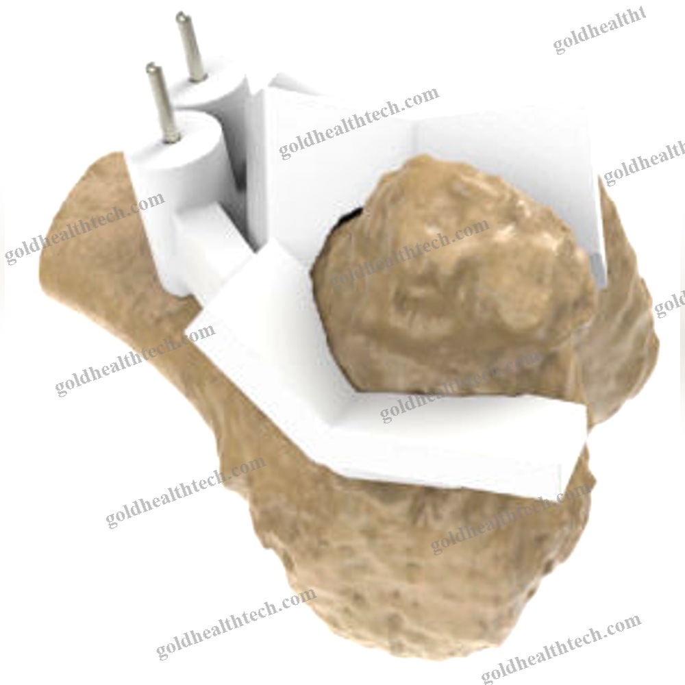 Hip Prosthesis Resection Guide