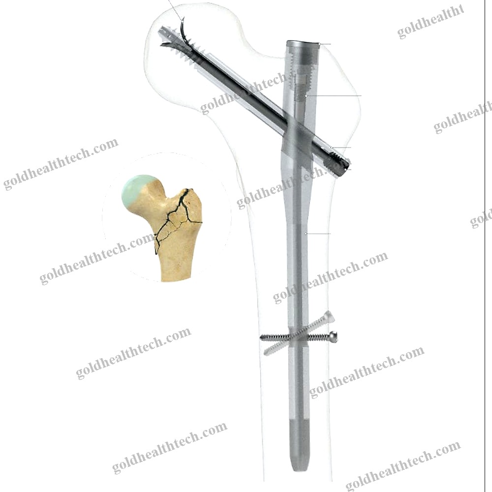 Femoral Intramedullary Nail