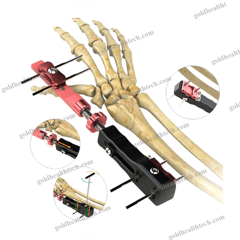 Wrist External Fixation System