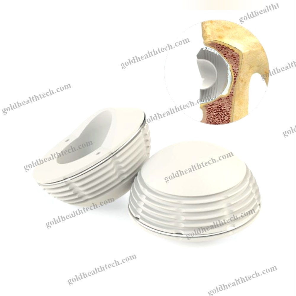 Cemented Acetabular Prosthesis