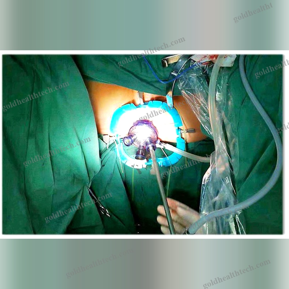 Sternal Retractor