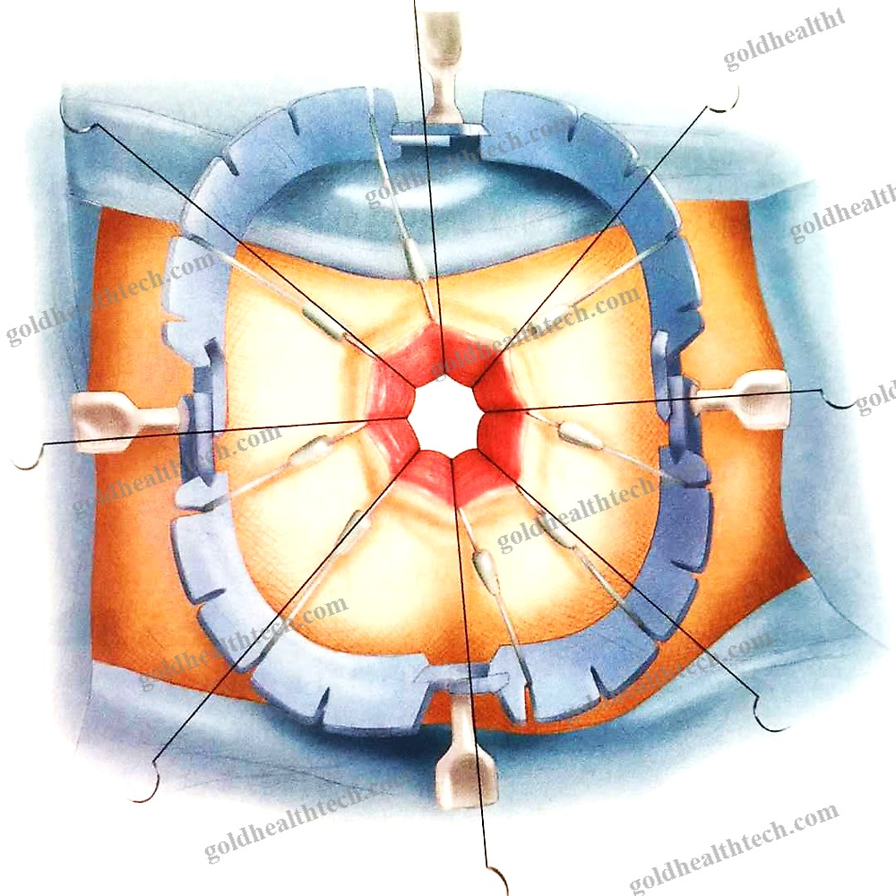 Sternal Retractor