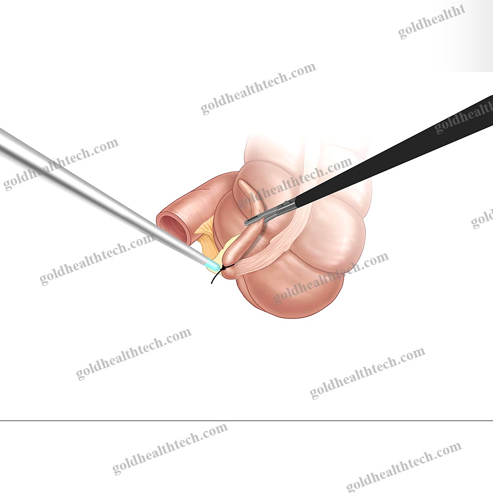 Laparoscopic Electrode