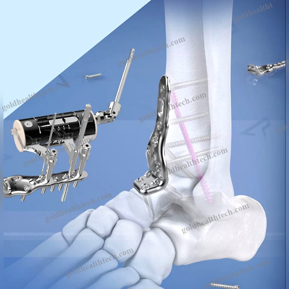 Tibia Compression Plate