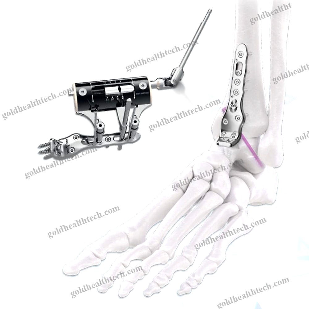 Tibia Compression Plate